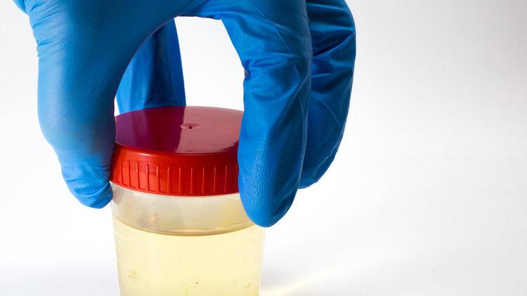 疾病|肾脏不好，小便先知，当尿液出现这4种异常时，可能肾脏已受伤