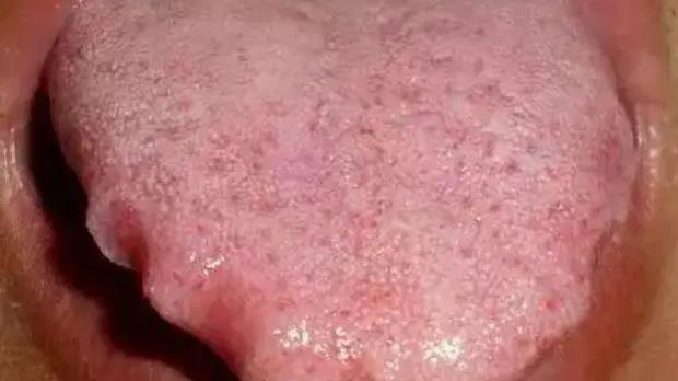 伤肾|舌头是人体自带体检表，舌头出现这些信号，赶快去医院