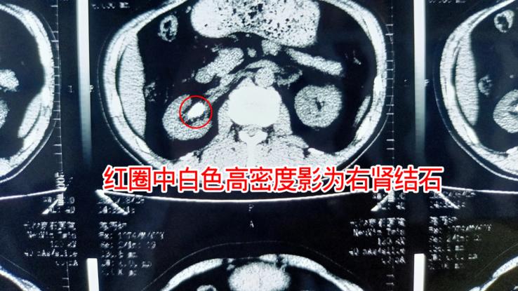 酱油|男子身患结石反复尿血5月，直至尿液呈酱油色紧急就医治疗