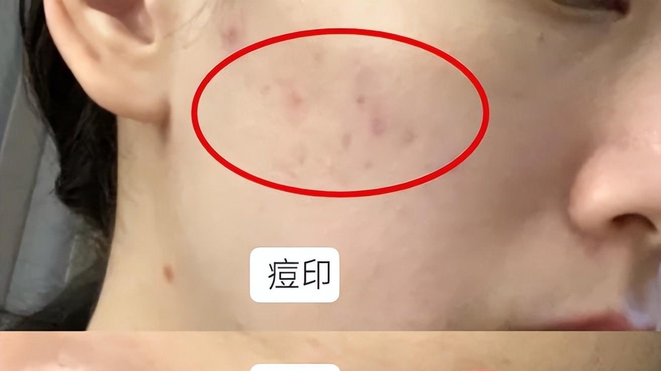 痘痘|十问十答，夏季脸上长痘常见问题解答，避坑指南