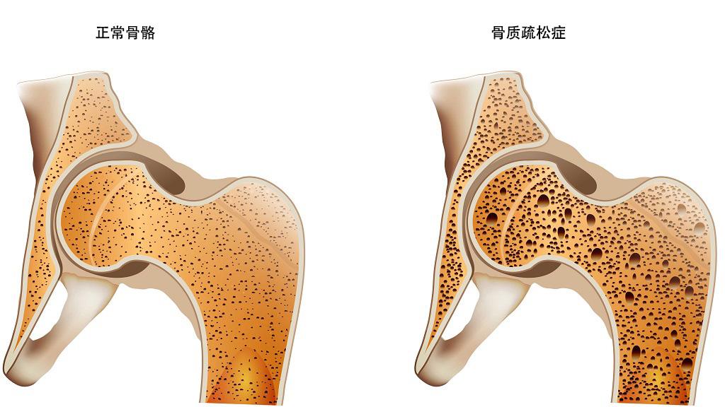 面粉|降低骨折风险！骨质疏松症新药Evenity增加骨形成同时减少骨丢失