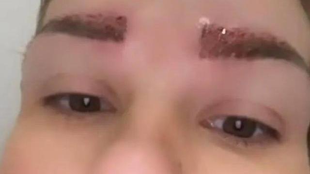 医生 追求浓眉，英国妹子把头发种到眉毛上。现在眉毛疯长，这画风简直了