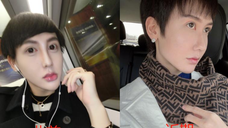 整容|网红周楚娜整容花费400万！五年整容超百次，曾说眼睛大到闭不上