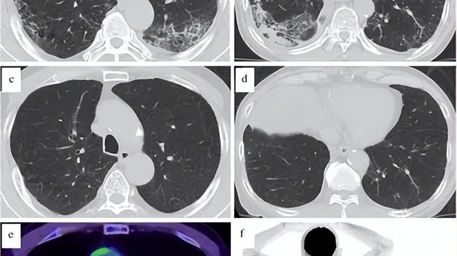 免疫治疗|案例：68岁肺大细胞神经内分泌癌患者接受免疫治疗后4年未复发