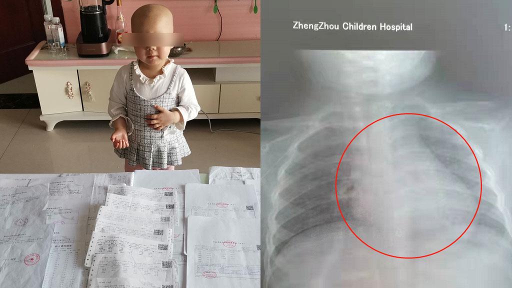 肿瘤|3岁女童胸腔肿瘤如成人拳头大小