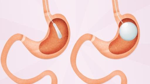 胃镜 胃内球囊，是什么装置？为何会有减肥作用？