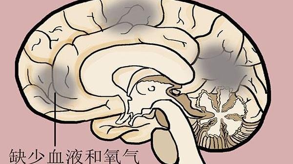 安神|过了60岁，预防脑梗塞其实并不难，做好这4点，护血管，远离脑梗