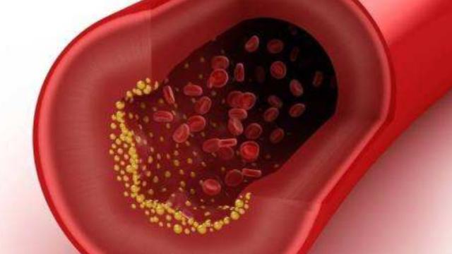 老中医|真正能软化血管的并非大蒜，而是它，若能坚持，或许血管会感激你