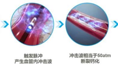 眩晕|血管内冲击波：冠状动脉钙化处理的技术革新