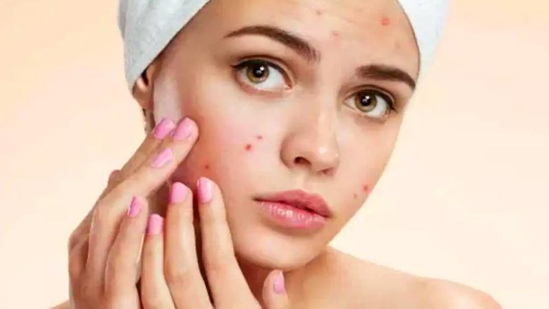 米饭|普通痘痘VS不普通痘痘，这点真的很重要！