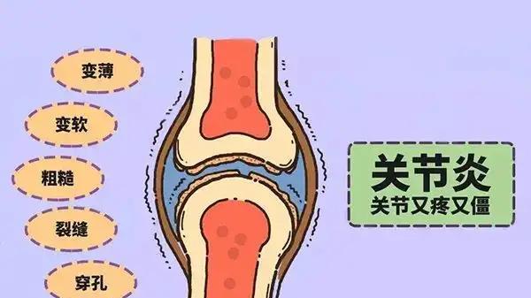 通便|人体八大关节易受侵害，关节不适建议做这些检查