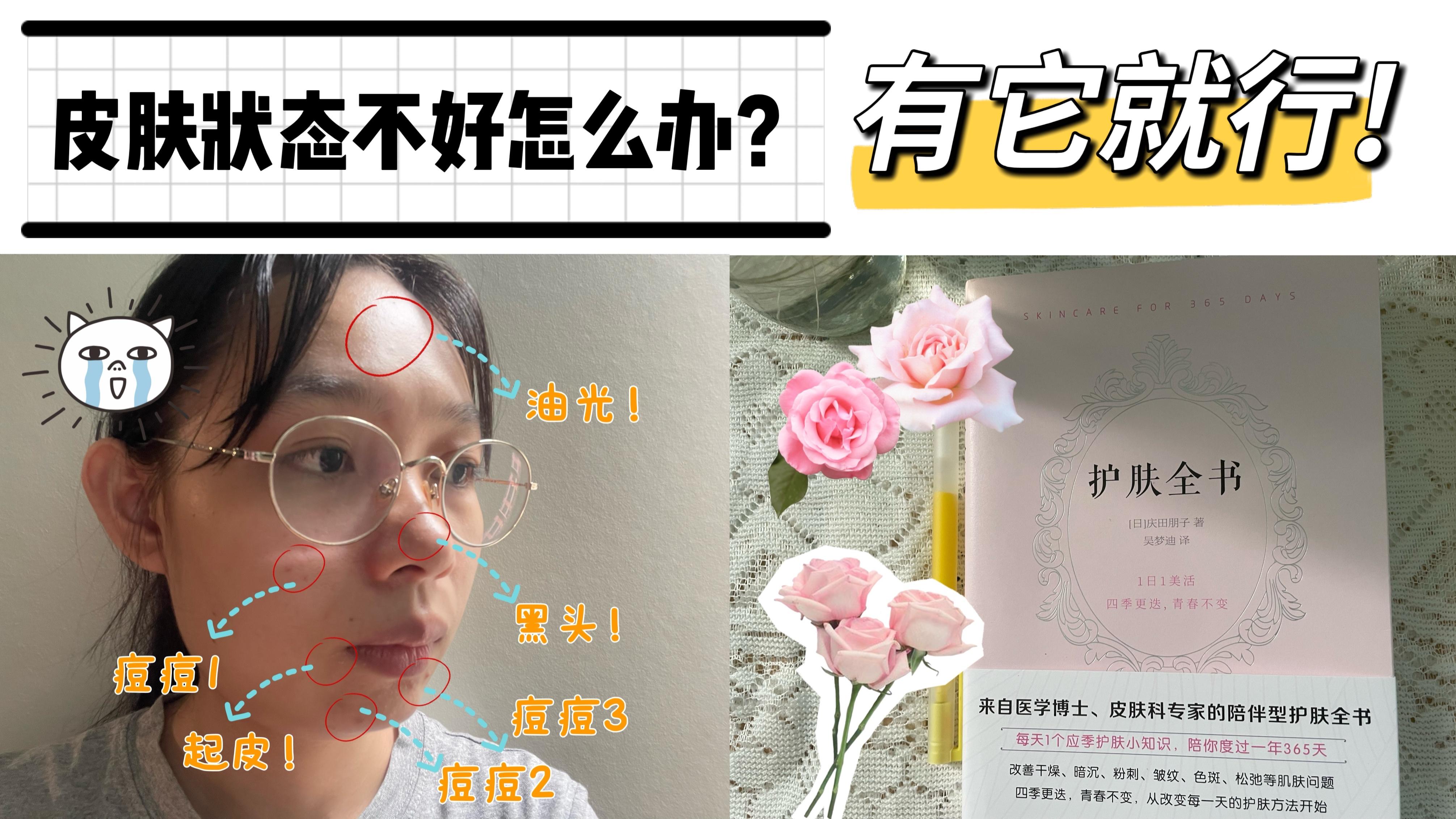 痘痘 皮肤状态不好怎么办？脸部爱出油、黑头、痘痘、起皮，有它就行！