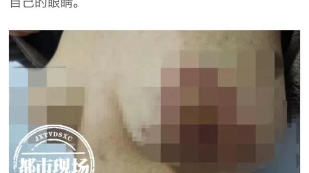 整形 女子生子后胸部下垂，花10万到医院整形，哭诉：整毁了都不敢看！