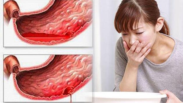 蔬菜|胃出血最容易识别的典型迹象，赶紧发给家人看看