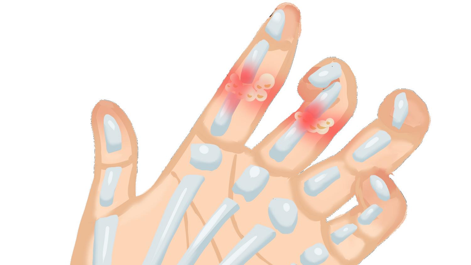 痛风|警惕痛风关节炎，3点自查，尽早发现与治疗！