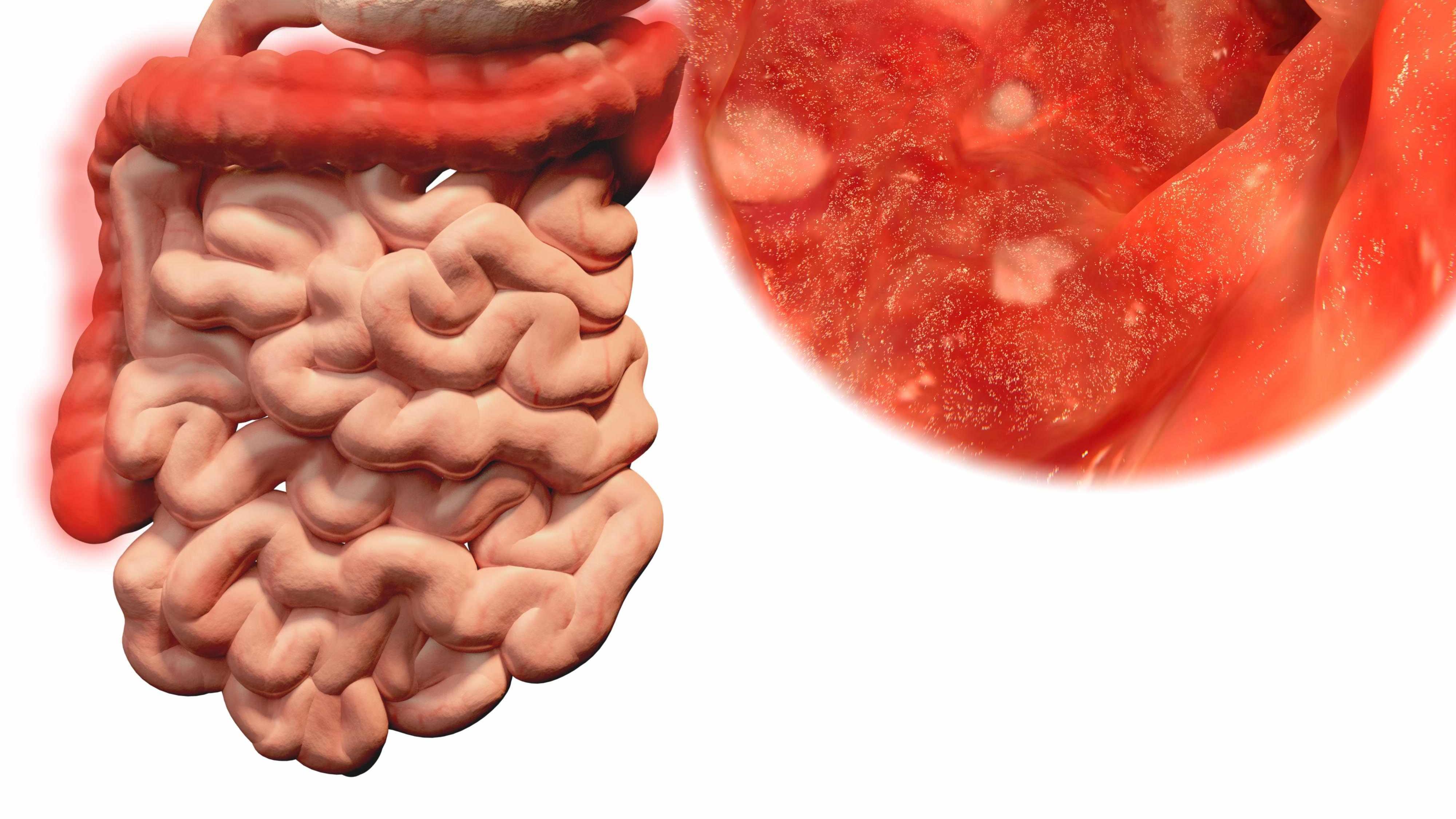 鼻炎|医生：大便出现这些异常，说明肠道长“息肉”了，需及时就医治疗