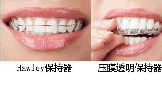 癫痫病|为什么矫正后还要戴保持器？