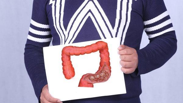 肠癌|肠胃不好的人，可能会出现“3多2痛”，需预防肠癌