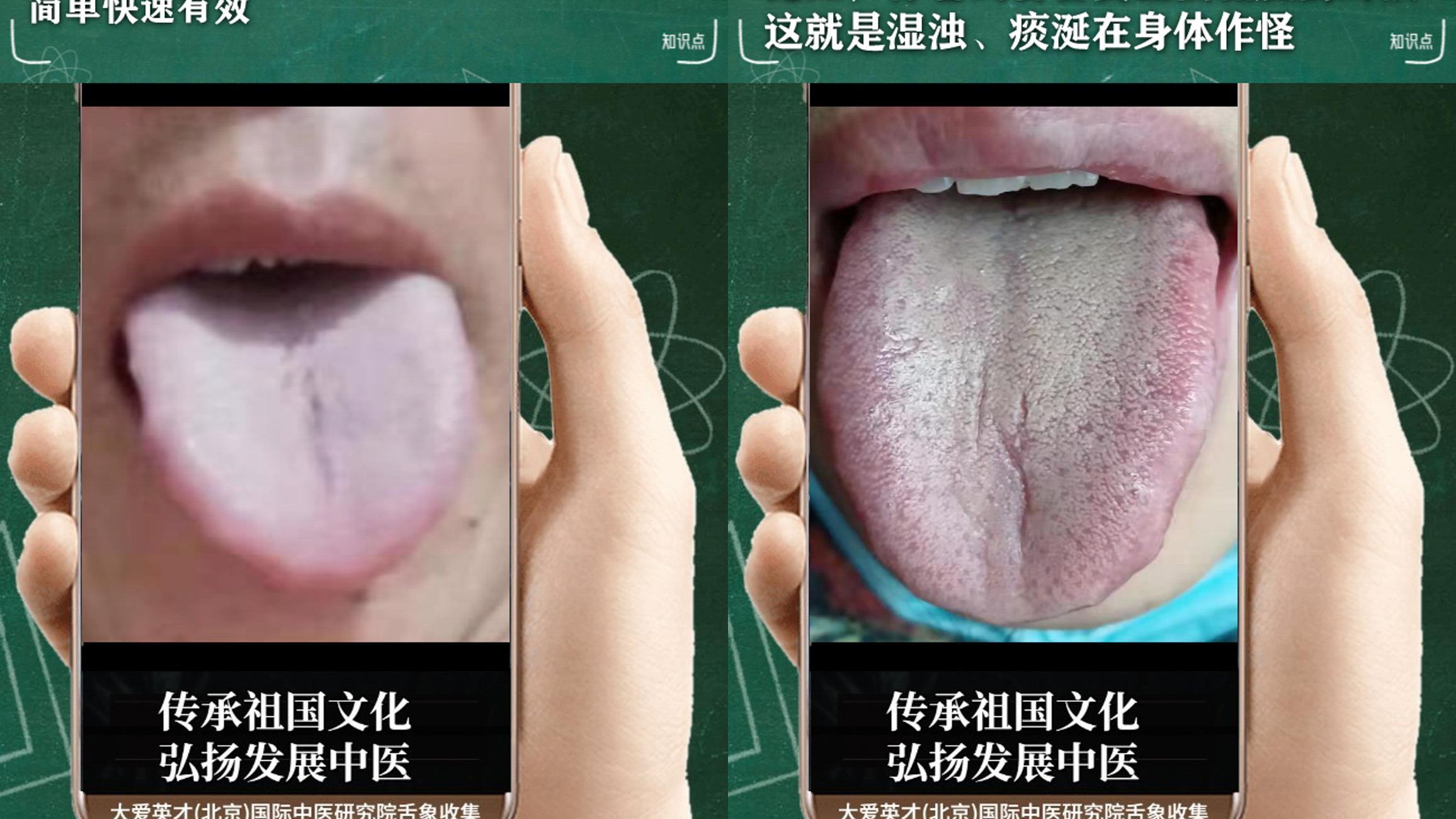 灰指甲|经常出现积食，腹泻，头晕目眩，脾胃失调的舌象讲解