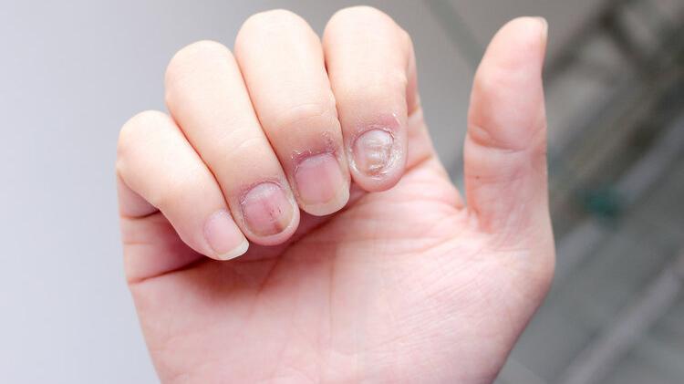 提醒：指甲若长成4种样子，可能是癌或疾病的信号，多留心观察