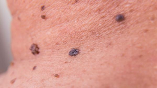 鸡蛋|身上有这5种痣出现，或增加癌变的几率，需留心观察，重视起来