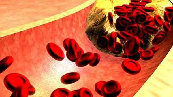 胆固醇|胆固醇太高，身体会给出4个提示，早些改善，防止血栓来“拜访”