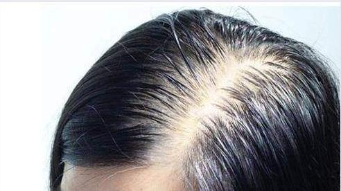 脱发|脱发秃顶，可能是这些原因引起的！