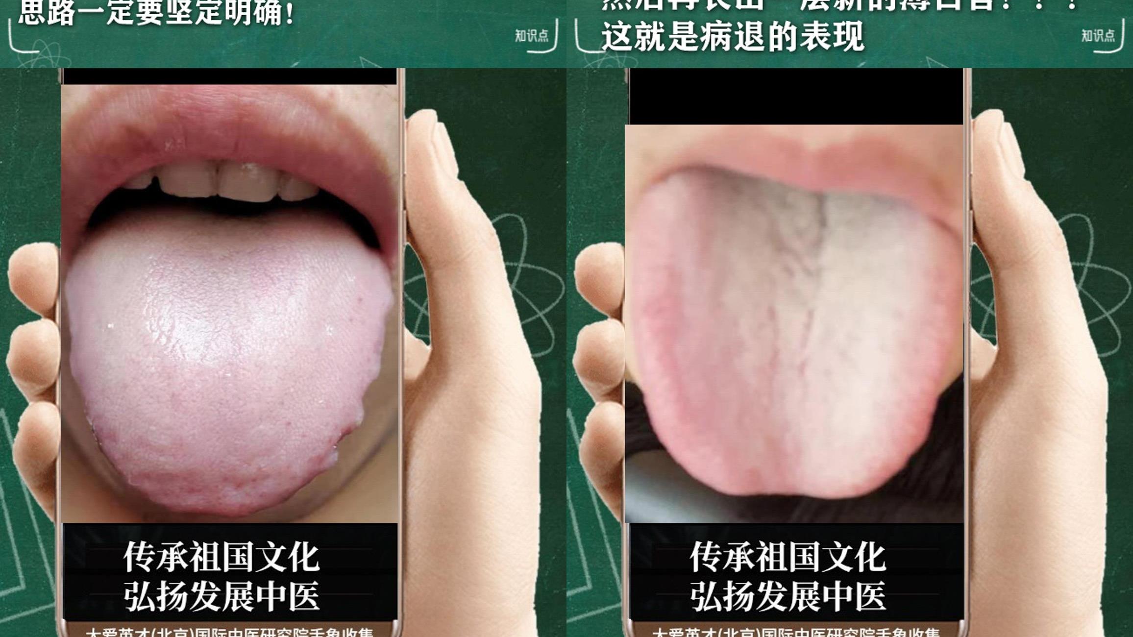 医生|中医分析：常愤怒，腰膝酸软，痰湿体质，经常复发很影响生活