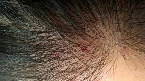 芡实|头皮总是长“疙瘩”和“脓包”，是咋回事？或是这3方面的原因