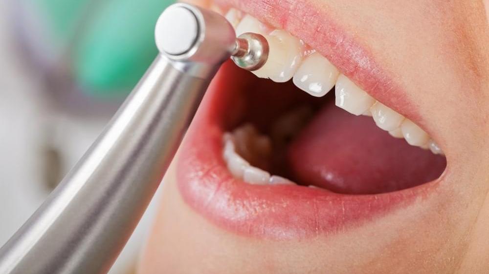 衰老|洗牙对牙齿有伤害吗？医生：不要盲目的洗牙，副作用别不在意