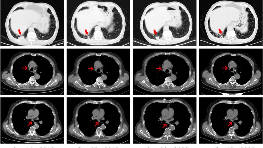 肿瘤|远处转移病灶不经治疗却得到部分甚至完全缓解