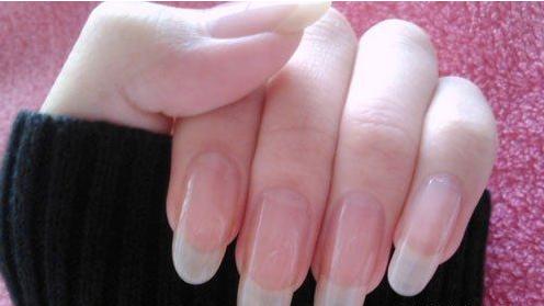 高血糖|手指甲一截红一截白？是不是林赛氏指甲？那可是慢性肾病的征兆