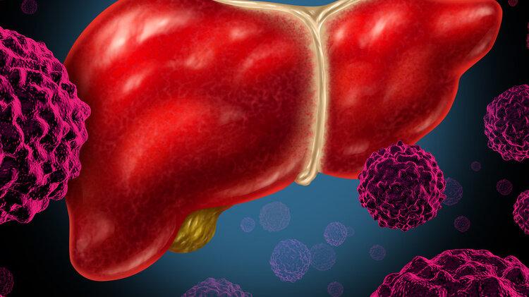 肝癌|全球近一半肝癌在中国，再三提醒：家中的3种食物，尽早撤下餐桌