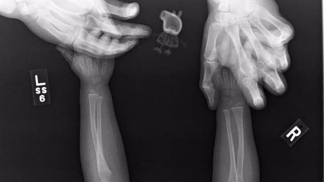 肺癌|盘点30张奇奇怪怪的X光片，看完整个人都不好了！