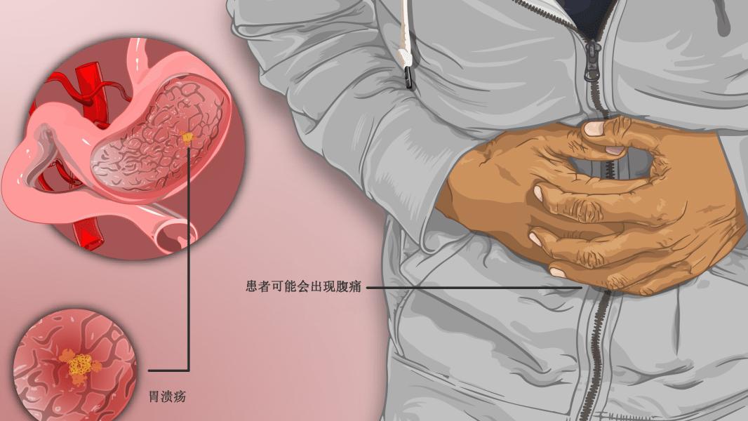 驼背|奥美拉唑创新型口服液体制剂！Konvomep获批用于活动性良性胃溃疡