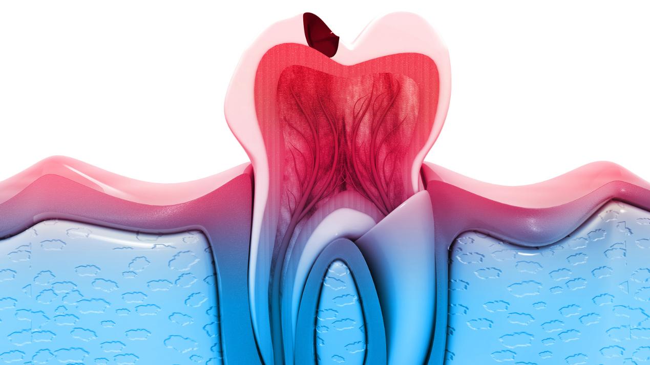 牙齿|上火牙痛、牙龈萎缩、牙齿松动多因“胃火盛和肾气虚”引起，中医妙方可“去胃火养肾