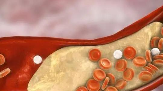 卵巢癌|高血脂人群：猪蹄、鸡蛋和牛奶，哪一个能吃？医生告诉你答案