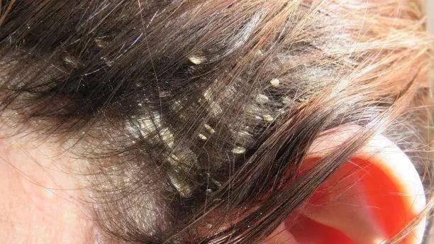 白术|坚持用“硫磺皂”洗头会怎样？或许能改善4大头皮问题，早做了解