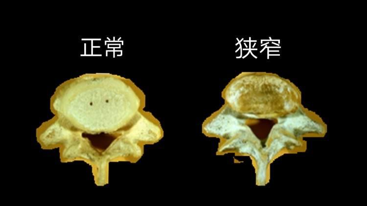 仁济医院|一分钟了解各类引起椎管狭窄的病因
