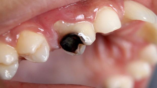 胃炎|蛀牙痛怎么办？