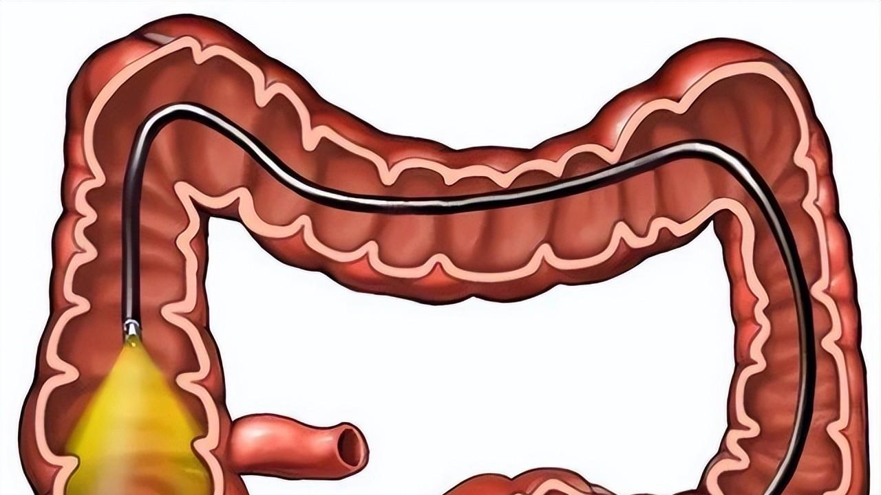 肠息肉|为什么肠道容易长“息肉”？肠内若有息肉，身体会有什么症状？