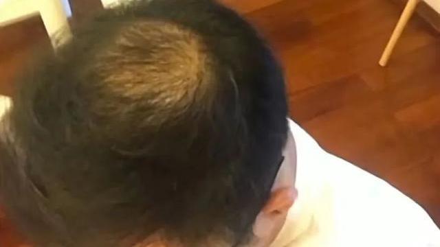 植发|不用洗发水洗头可以长头发，洗发水公司和植发公司都慌了！