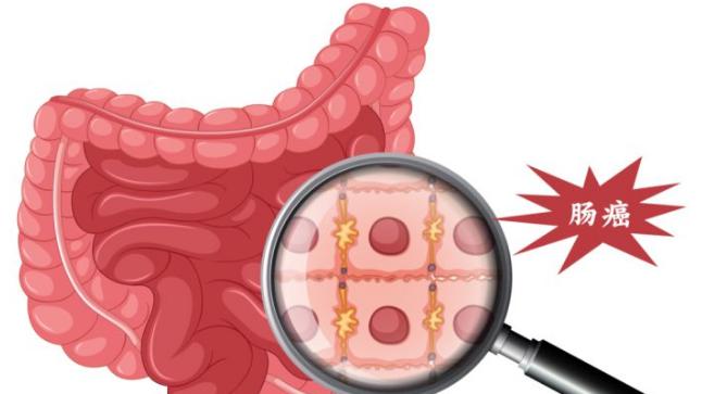 水果|做一次肠镜，能保几年平安？5年还是15年？医生告诉你答案！