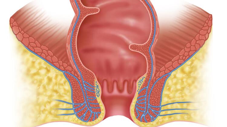 亚硝酸盐|如果一个人失去了肛门会怎样？中国百万“造口人”的困境，谁能懂