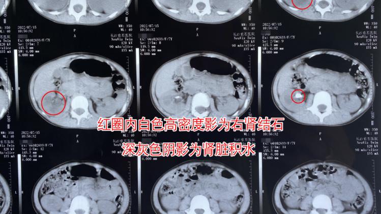 眼底病|7岁女孩发热不适误当感冒，全身体检才知竟是结石感染所致