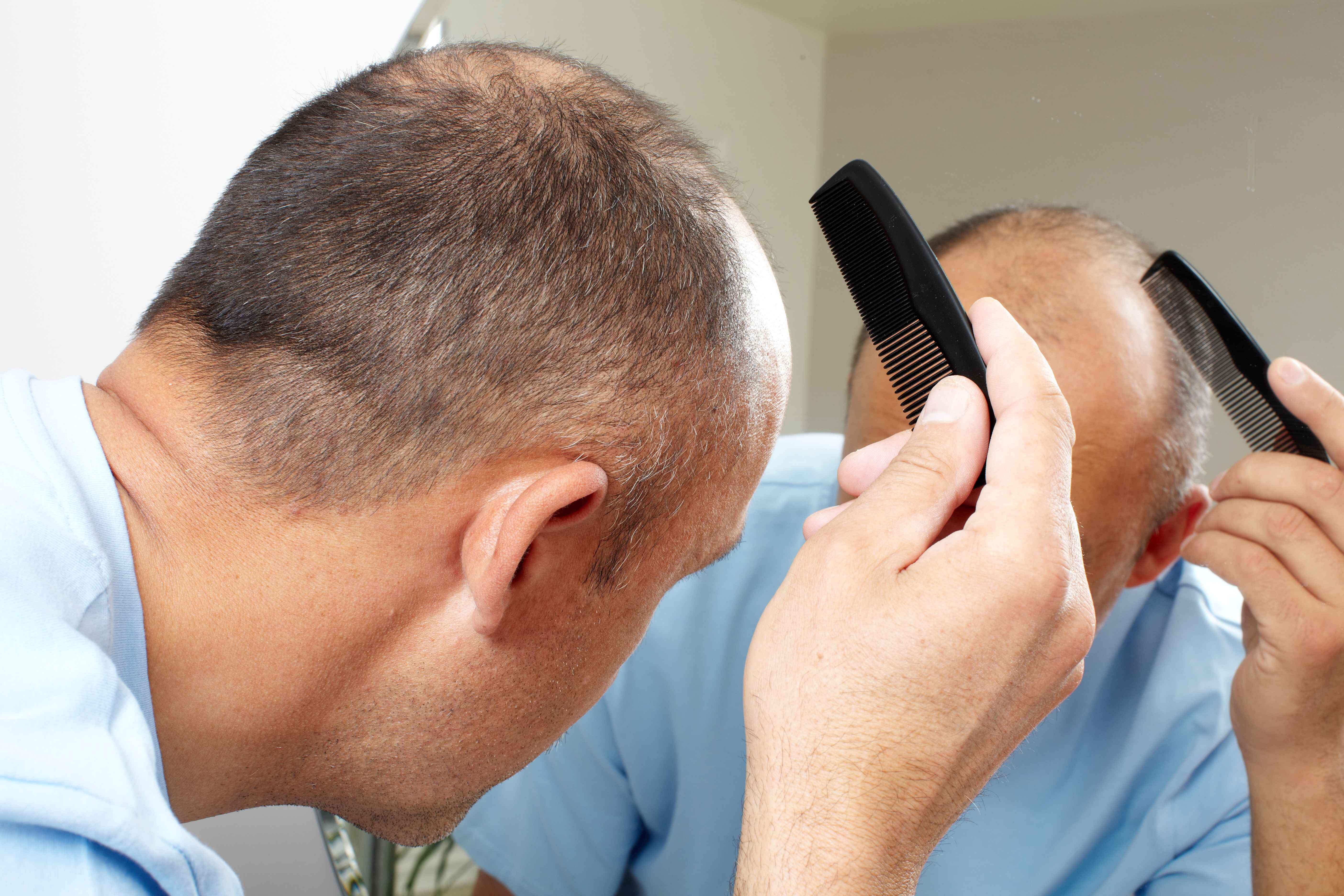 高血压|男性想要看起来年轻，要预防脱发，做好这4件事有效延缓脱发