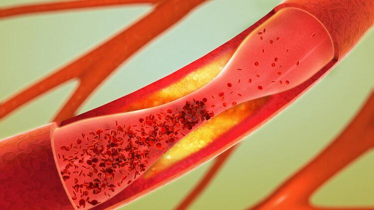 静脉血栓|血栓来临，手脚先知？提醒：手脚若出现3种异常，或许血栓已来临