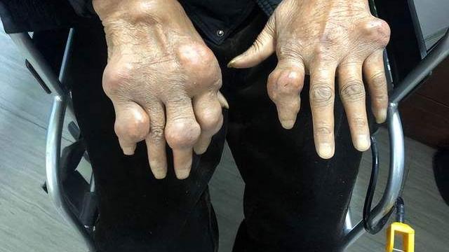 按摩|类风湿患者抹药按摩有作用吗