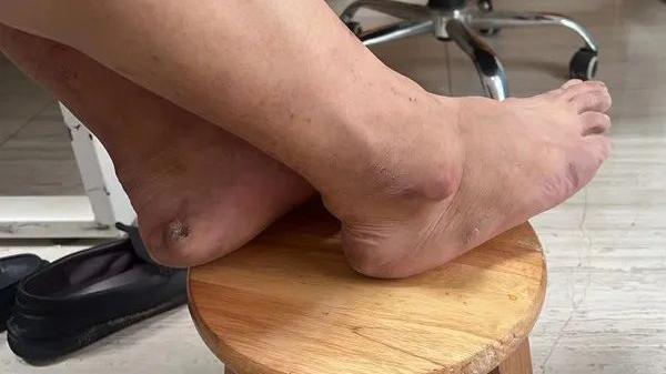 尿酸|教你一个方法，让你少吃药还能把尿酸降下去！