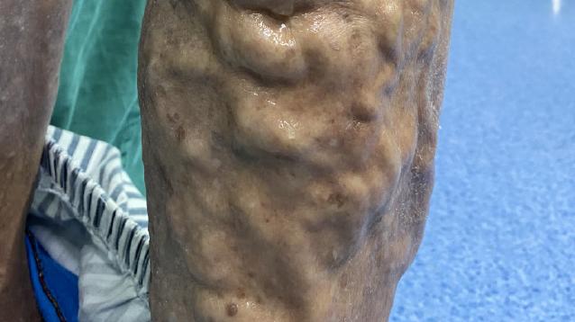 皮炎|有几千万病友的下肢静脉曲张究竟是什么病？钟大夫用你懂的让你懂。